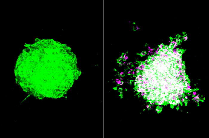 Сфероид из раковых клеток после заражения бактериями Fusobacterium nucleatum начинает разваливаться (справа, бактерии окрашены розовым) — клетки стремятся мигрировать из сфероида. (Иллюстрация: Fred Hutchinson Cancer Center)