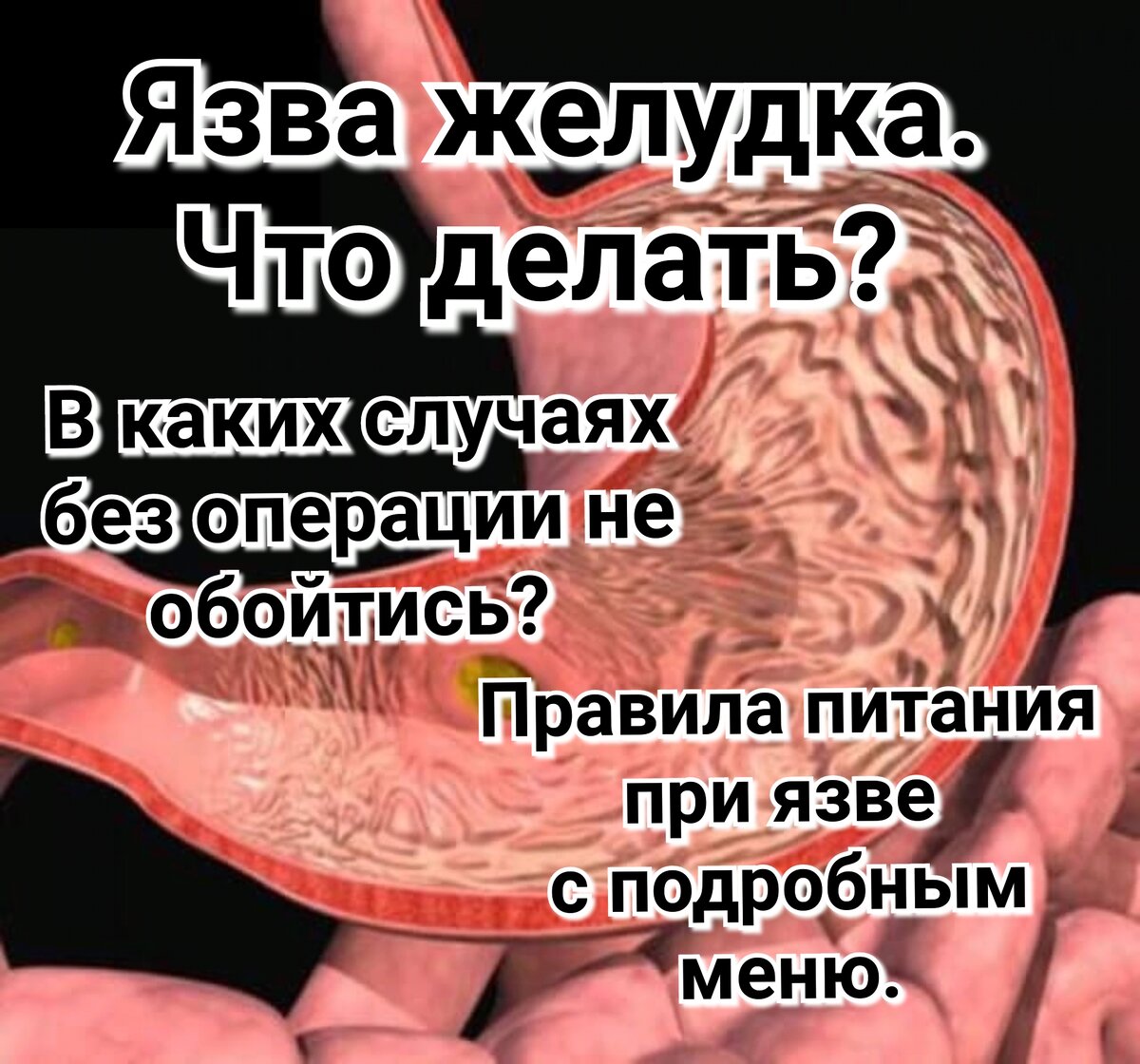 Язва. Что делать? Подробное меню при язве. Когда нужна операция? | Просто о  сложном (советы хирурга, травматолога-ортопеда) | Дзен