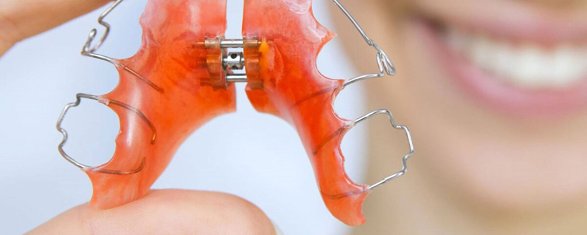 Расширение зубного ряда происходит за счет поэтапного раскручивания винта в центре конструкции