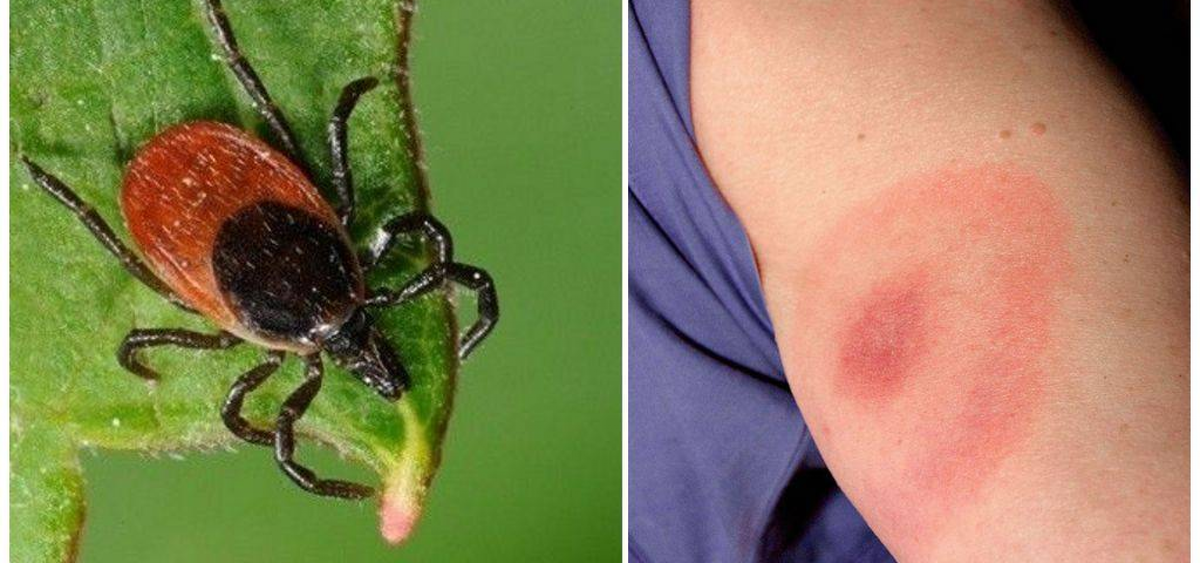 Фото с сайта https://zdrav-list.ru/news/ukus-kleshha-ukazyvaet-li-krasnaya-syp-na-borrelioz