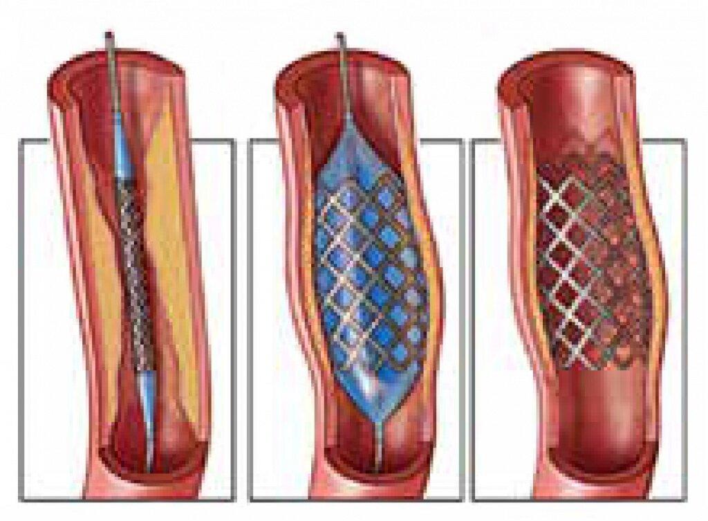 Se puede cambiar un stent