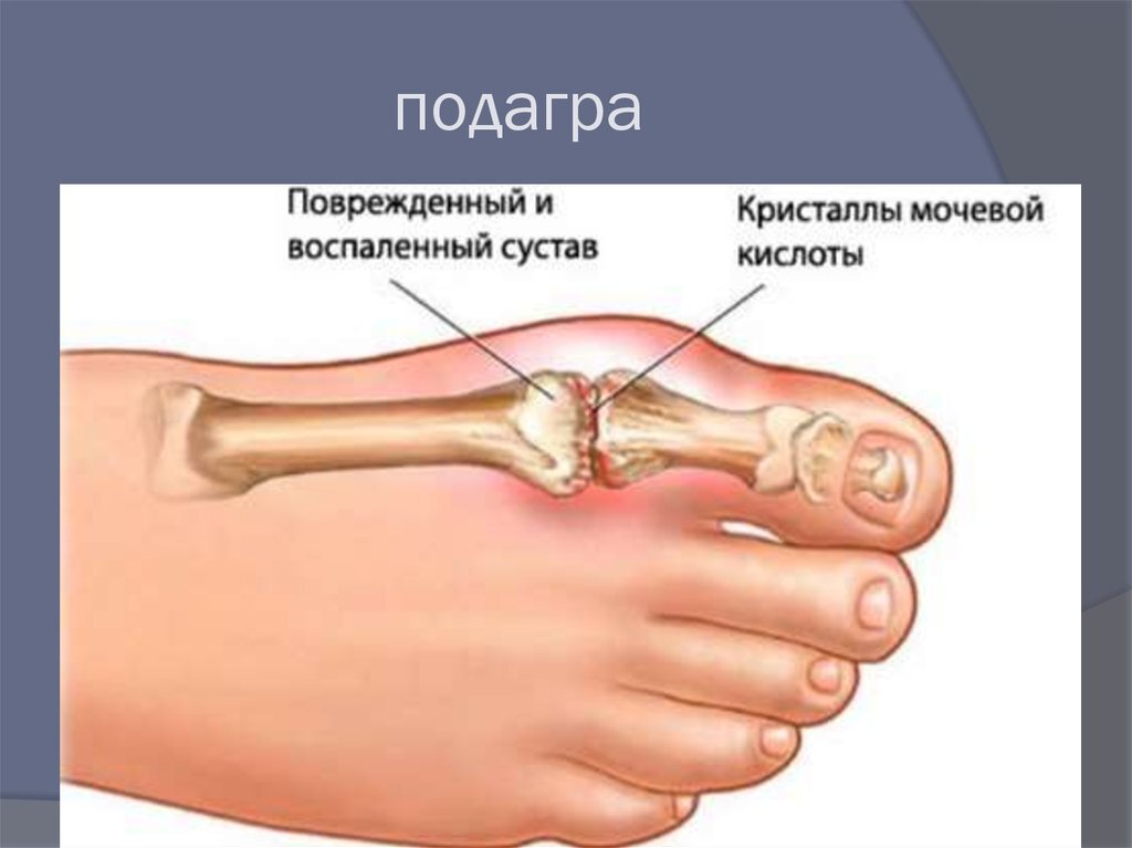 Повышенная мочевая кислота подагра