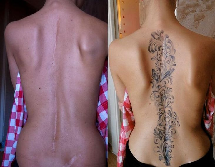 Шрамы и тату: Всё что нужно знать о перекрытие шрама татуировкой