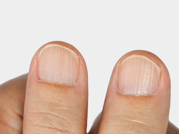 Причины появления продольных полос на ногтях рук