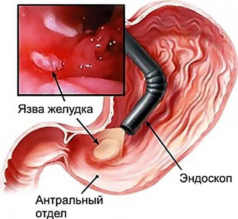 Язвенный гастрит. Язвенная болезнь желудка ФЭГДС. ФГДС двенадцатиперстной кишки. Гастроскопия желудка гастрит.