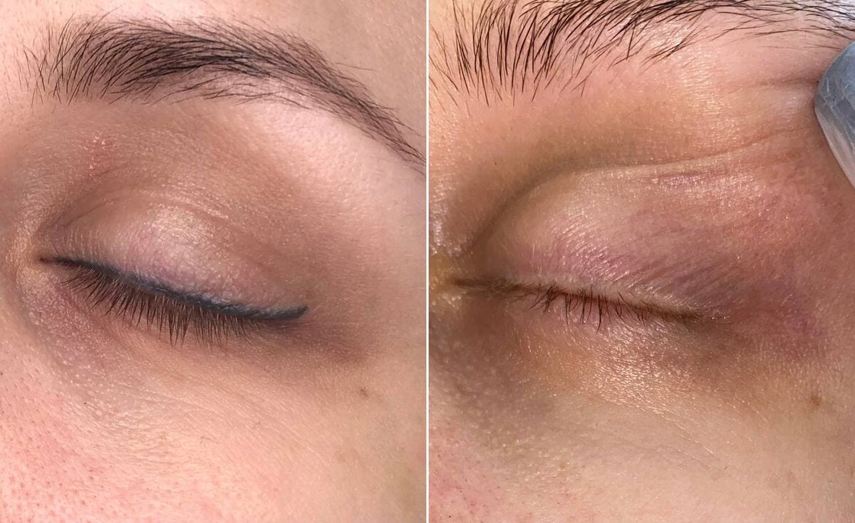 Удаление перманентного макияжа лазером