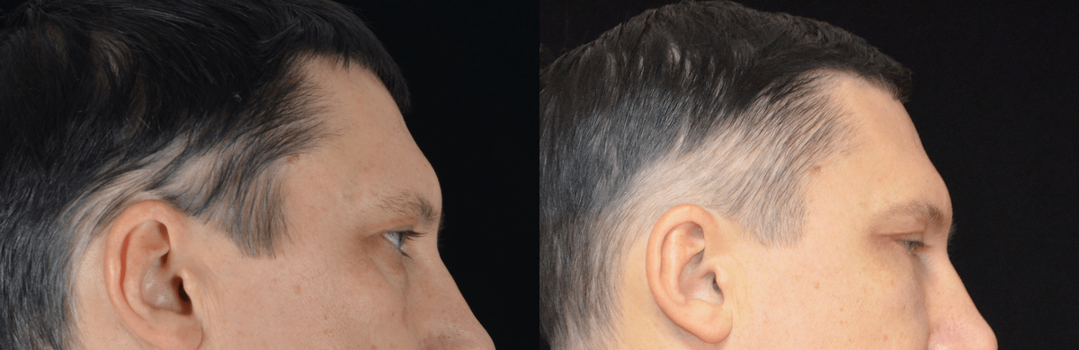 Блефаропластика нижних век. Фото с сайта Д.Р. Гришкяна. Имеются противопоказания, требуется консультация специалистов