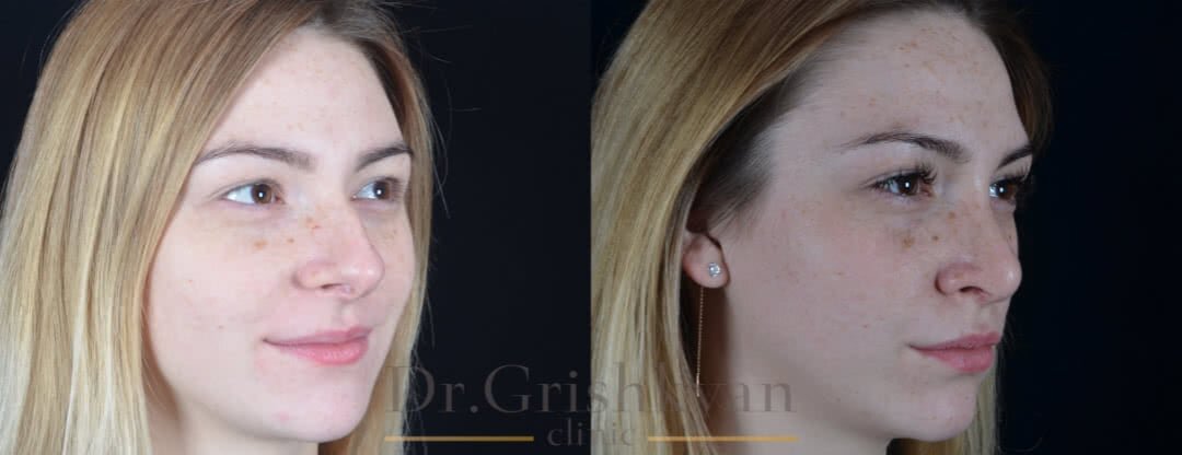 Фото до и после ринопластики. Фото с сайта Д.Р. Гришкяна. Имеются противопоказания, требуется консультация специалиста