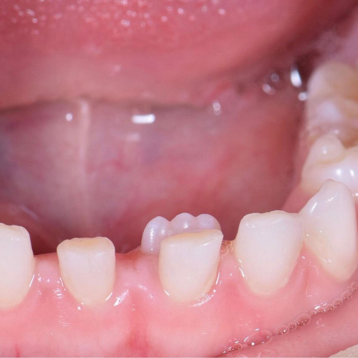 Особенности лечения скученности зубов у подростков и взрослых