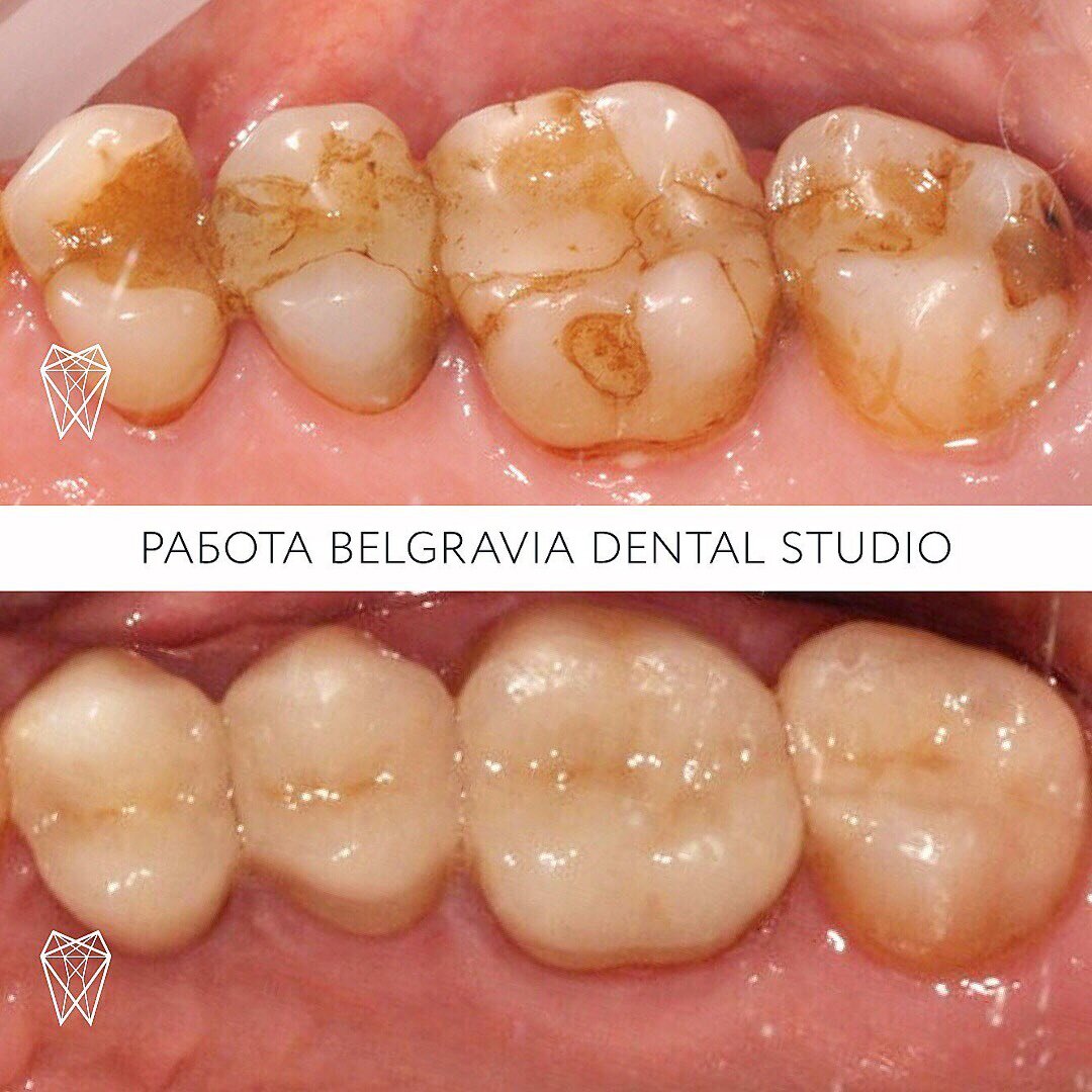 Старые пломбы могут потерпеть? | Стоматология Belgravia Dental Studio | Дзен