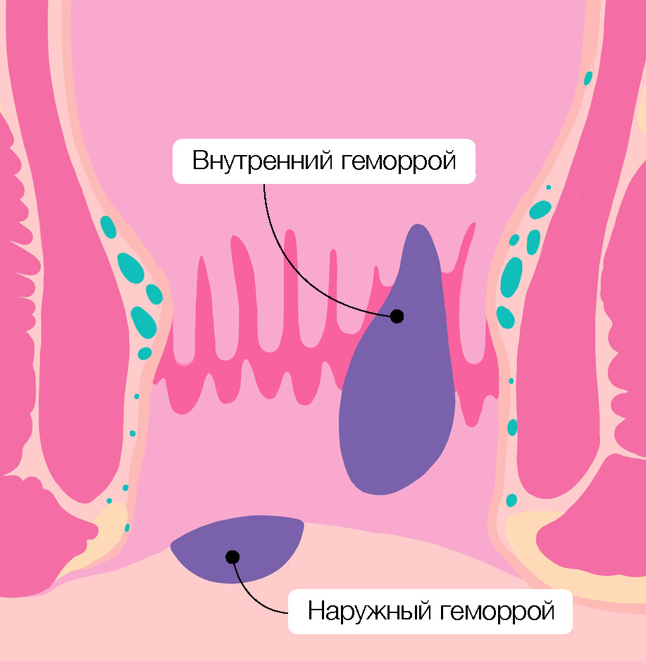 Геморрой у беременных - в 1, 2 или 3 триместре, причины, что делать