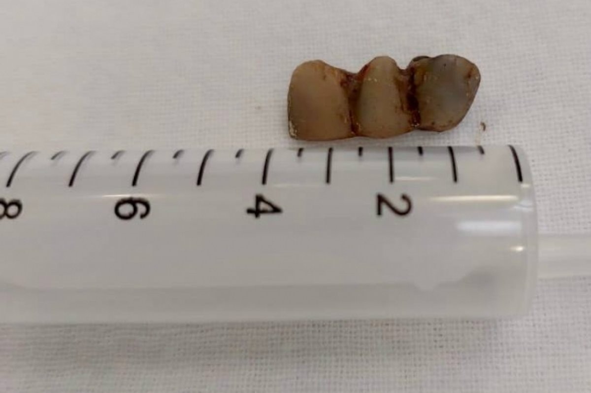    Пенсионерку, год жившую с зубным протезом в бронхах, спасли в Петербурге