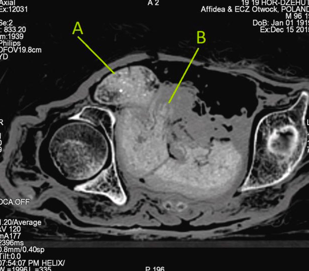 Буквой А на КТ плода обозначена голова зародыша, буквой В – рука Фото: Warsaw Mummy Project