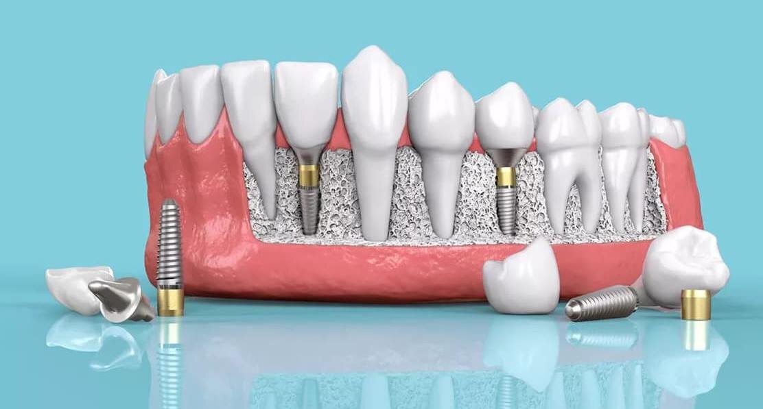 Зубные имплантаты заменяют корни зубов
