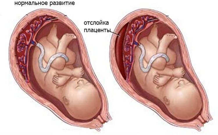 Преждевременная отслойка плаценты - что делать и как определить - ISIDA