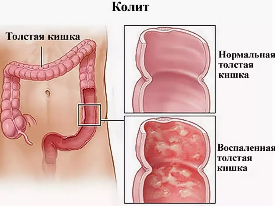 Лучевая болезнь: симптомы, формы, лечение