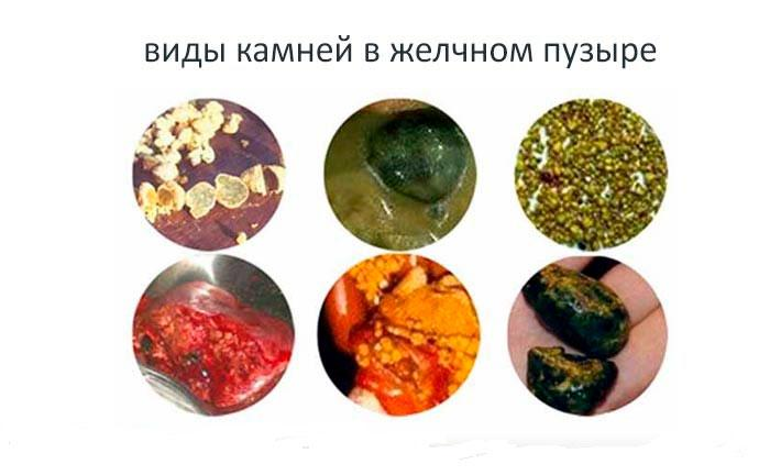 Камни в желчном где боли. Смешанные камни ЖКБ камни. Билирубиновые камни в желчном пузыре растворение. Холестериновые камни в желчном. Желчнокаменная болезнь холестериновые камни