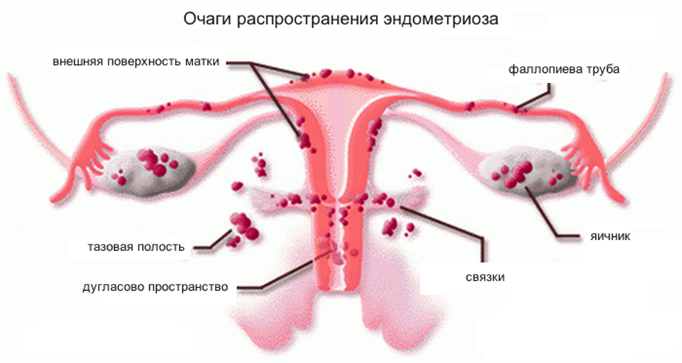 Эндометриоз матки что это. Эндометриоз яичников маточных труб. Эндометриоз механизм развития. Наружно генитальный эндометриоз. Наружный эндометриоз клиника.