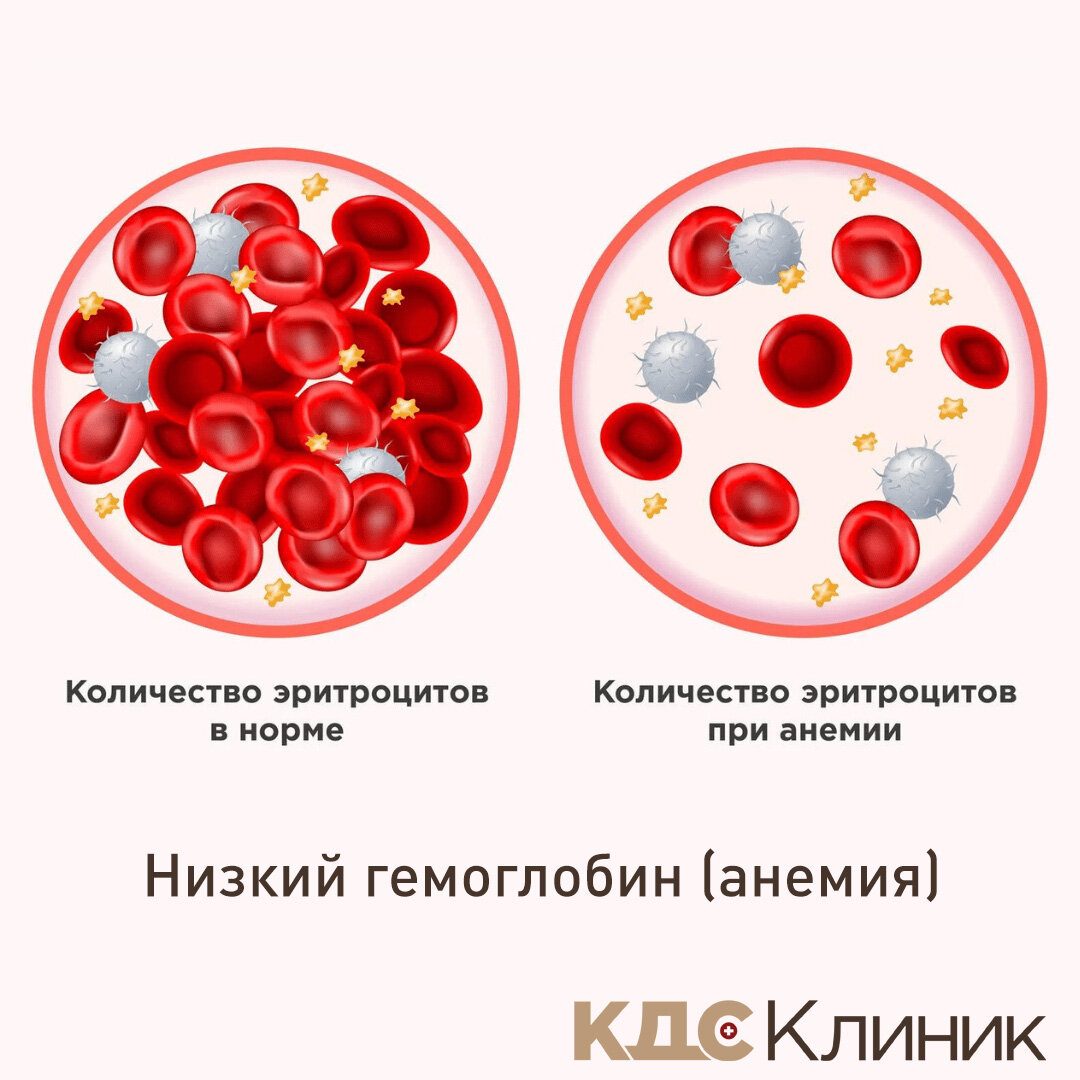 Низкий гемоглобин – откуда берется? Чем опасен? Как повысить? | КДС Клиник  | Дзен