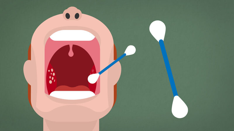 Хронический тонзиллит - симптомы и лечение