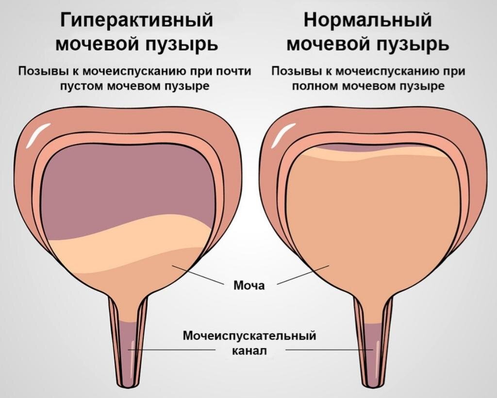 Синдром мочеиспускания. Гипо активный мочевой пузырь. Гиперактивный мочевой пузырь. Гипоактивый мочепвой пузырь. Нейрогенный гиперактивный мочевой пузырь.