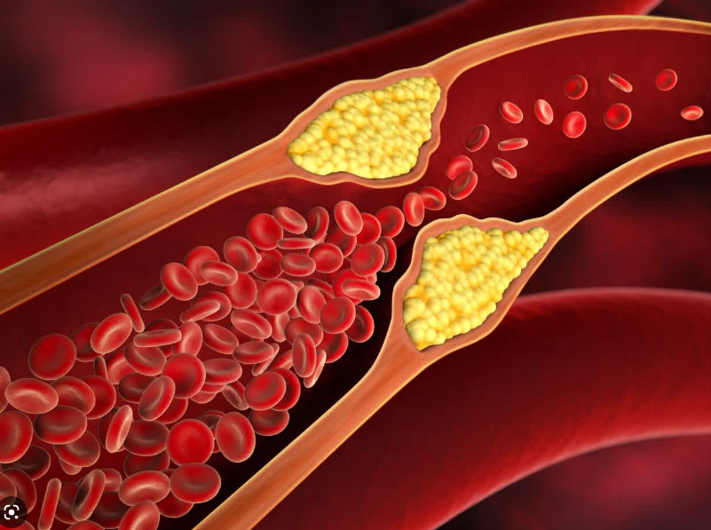Холестерин который затрудняет движение крови.