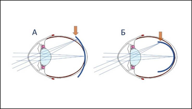 Отличие однофокальных очков от очков с миопическим дефокусом для контроля миопии