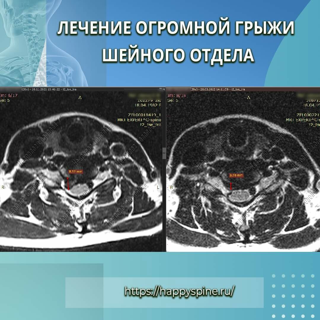 Промежуточный результат лечения огромной грыжи в шейном отделе | Красивая  осанка - здоровый позвоночник | Дзен