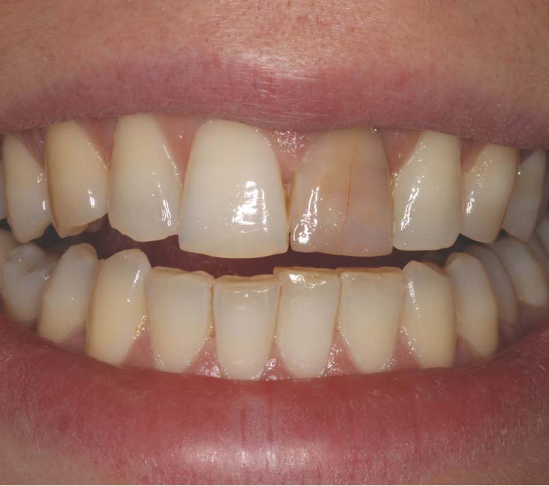 Зубы после 30. Дисколорит зубов тетрациклиновые зубы.