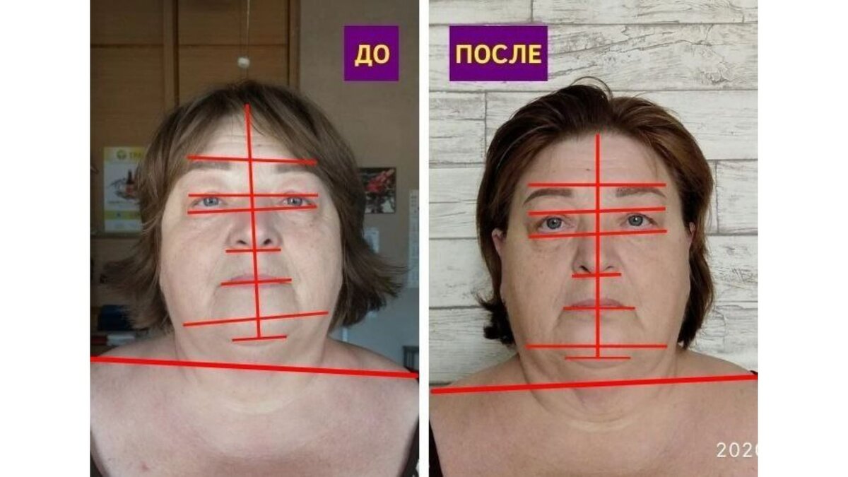 Спазм челюстных мышц - причина боли в затылке и шее. Расскажу как ...