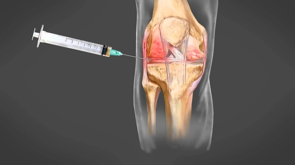 Уколы гиалуроновой кислоты в колено – панацея от невыносимой боли | ЗОКБ