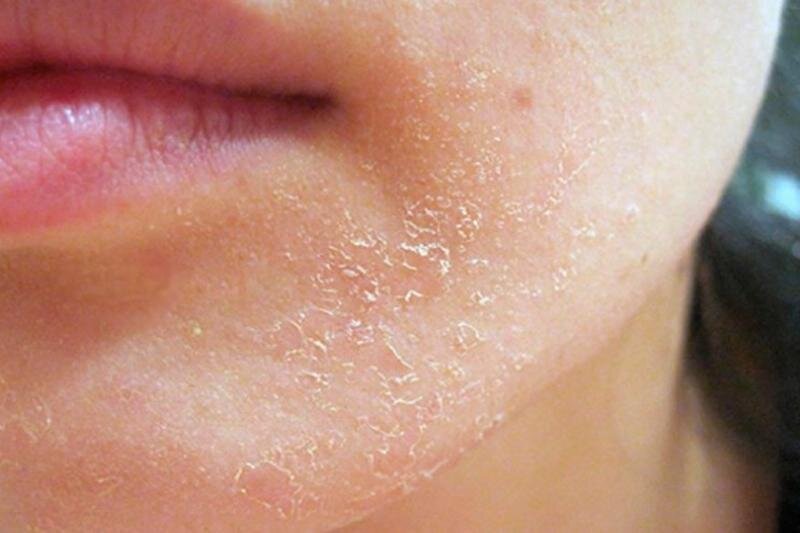 Почему шелушится кожа лица | Что делать если шелушится лицо