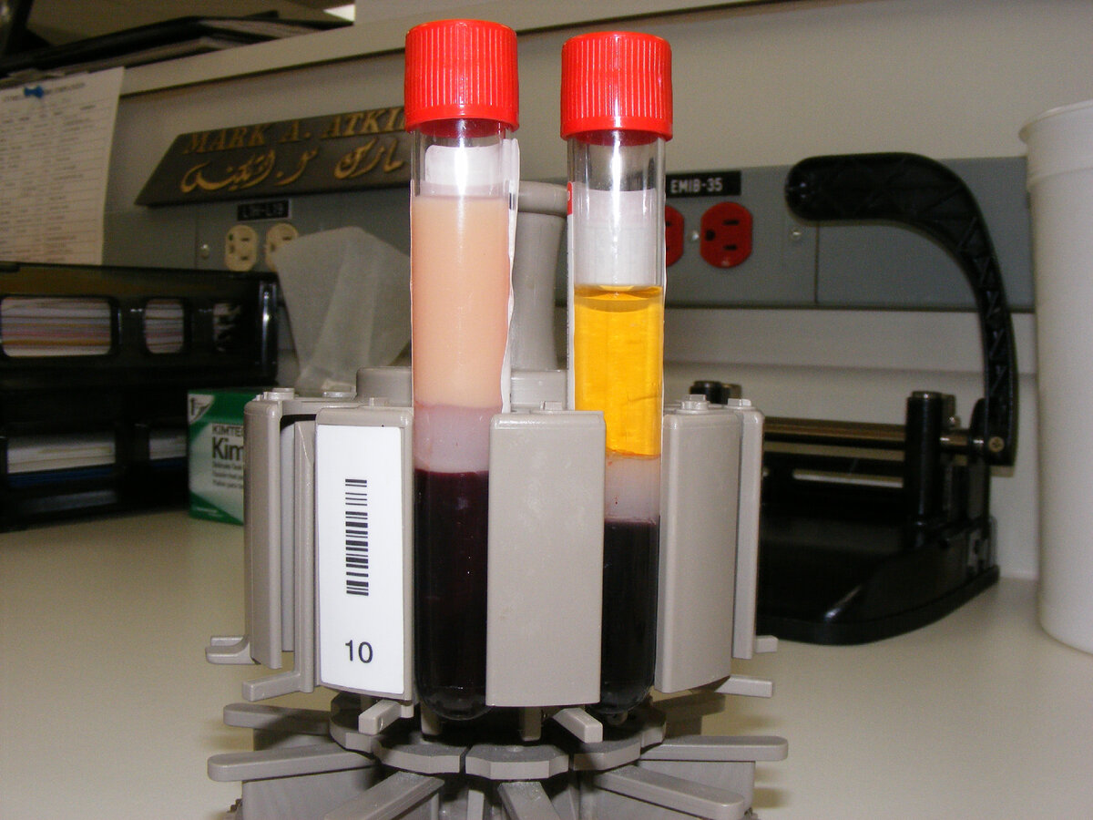 Чрезвычайный избыток липидов в крови окрашивает сыворотку крови в цвет молока. Клетки крови отцентрифугированы и видны внизу в виде темного слоя.