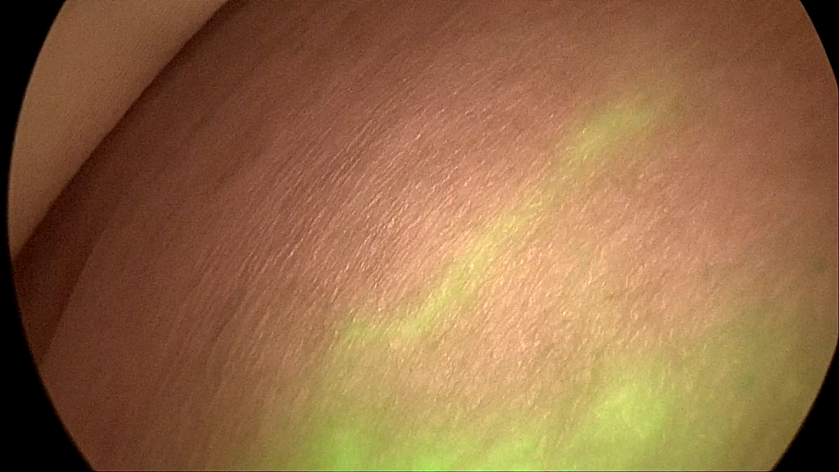 Доминантная дорожка лимфотока, которая визуализируется с помощью режима наложения видеосистемой IMAGE1 S™ RUBINA™ KARL STORZ. Автор изображения: к. м. н. Данила Александрович Денчик.