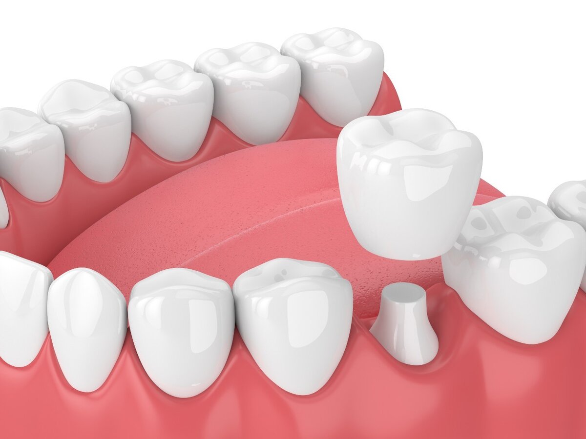Протезирование зубов инвалиду 1 группы. Персона Серов стоматология. Керамо композитные коронки. Стоматологические коронки.