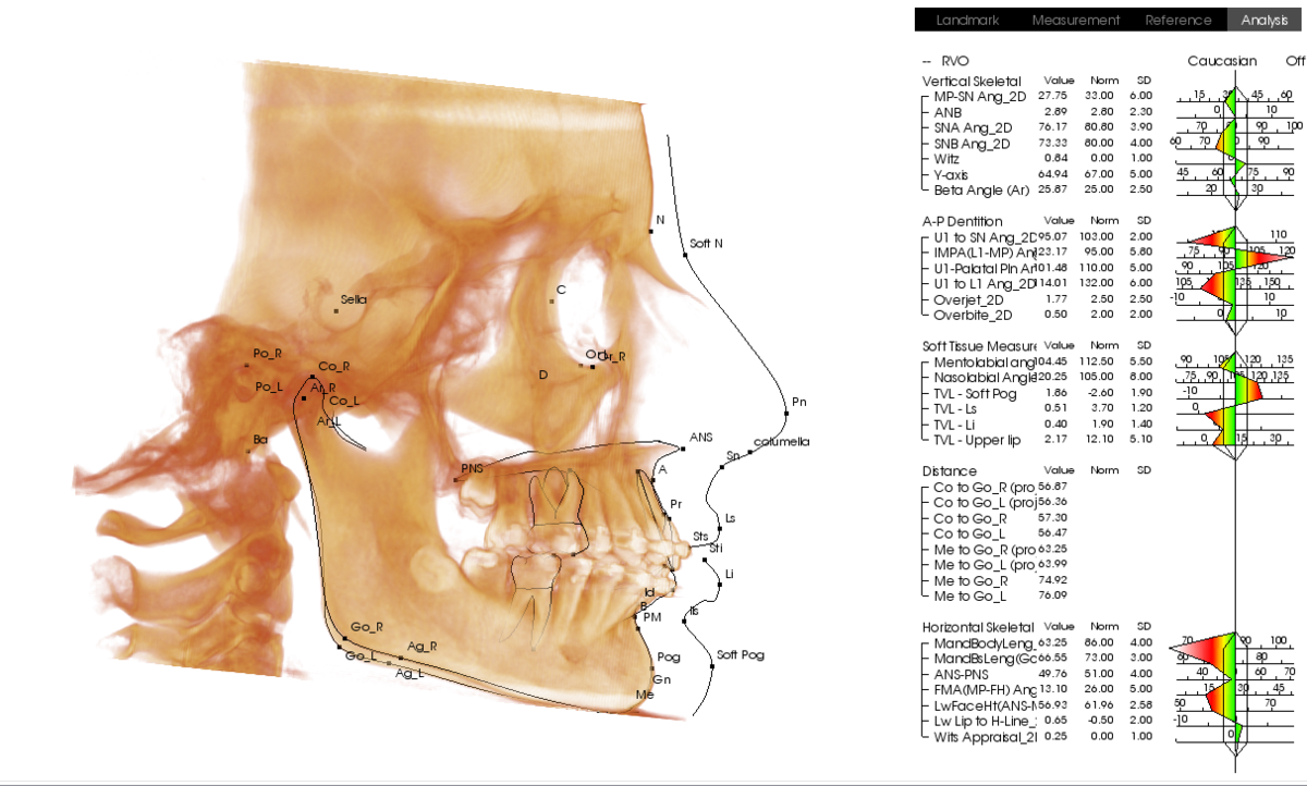 3Д-цефалометрия с необходимыми расчетами
