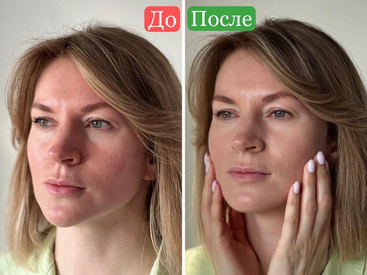 На фото слева — мое лицо утром после сна, справа — сразу после использования девайса UFO 2. Цвет лица стал здоровым, тон — ровным, ушли покраснения и отечность.