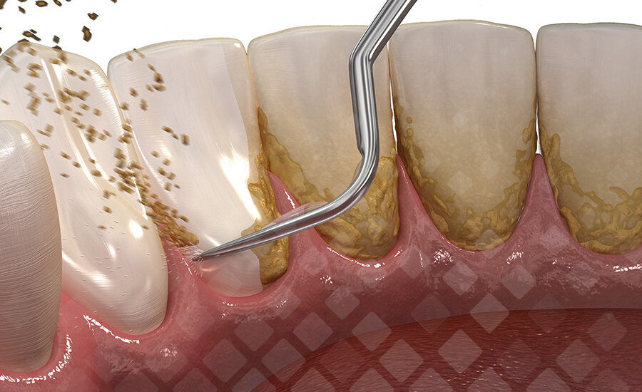 Твердые отложения снимают специальными ультразвуковыми и лазерными инструментами. Обычной щетке это не под силу. Фото: Яндекс.Картинки.