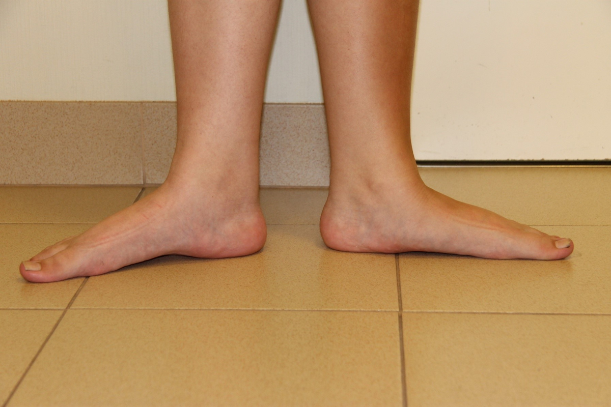 Плоскостопие на одной ноге берут ли. Продольное плоскостопие 3. Паралитическое плоскостопие. Ортопед продольное плоскостопие. Продольное плоскостопие 1.