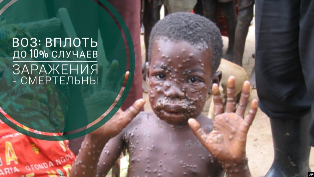Ребенок заражённый обезьяньей оспой