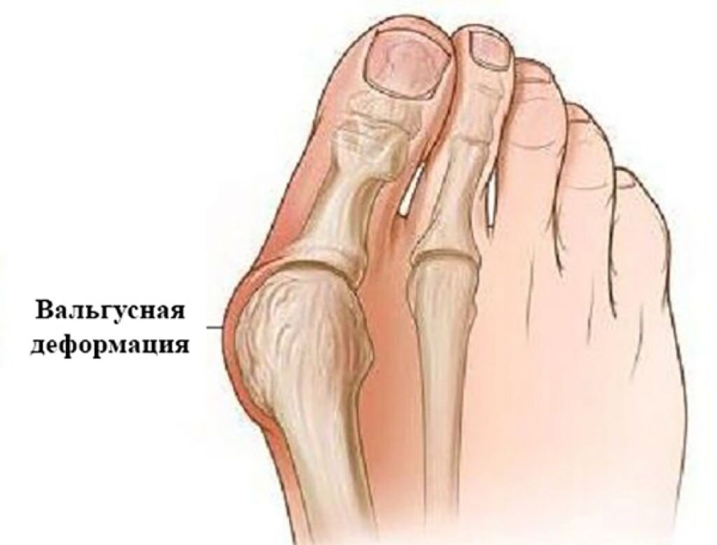 Лечение вальгусной деформации большого пальца стопы