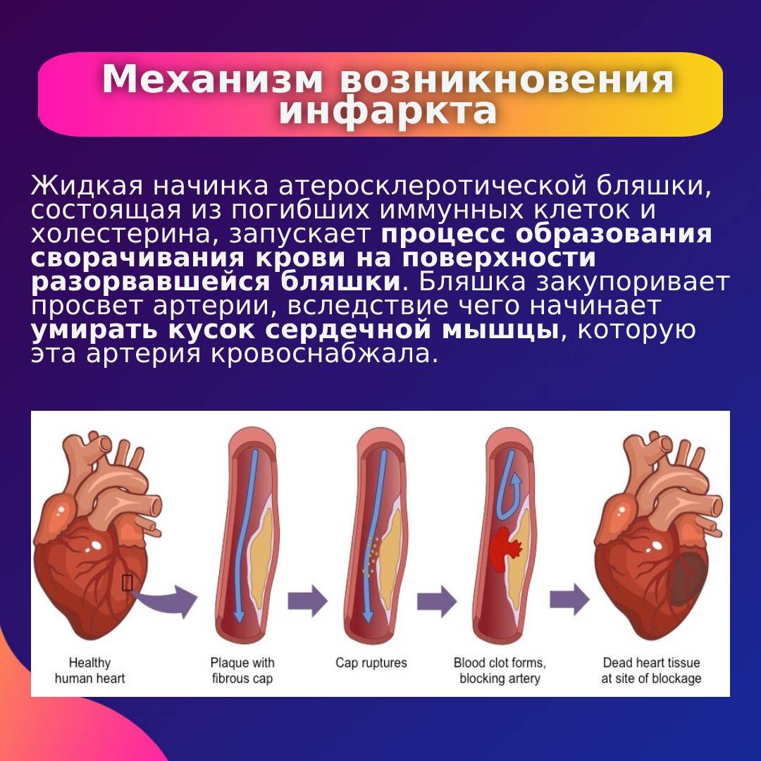 Больные инфаркта миокарда