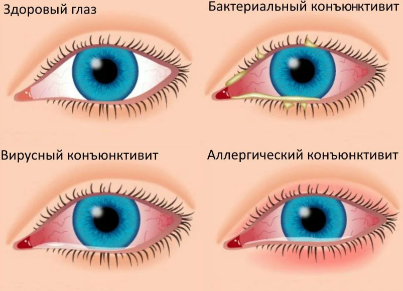 Формы конъюнктивита