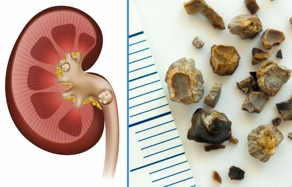 Как выходит камень из почки. Мочекаменная болезнь камни в почках. Коралловидный нефролитиаз. Мочекаменная болезнь оксалатные камни.
