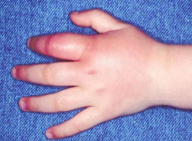 Рука начала отекать в считанные минуты