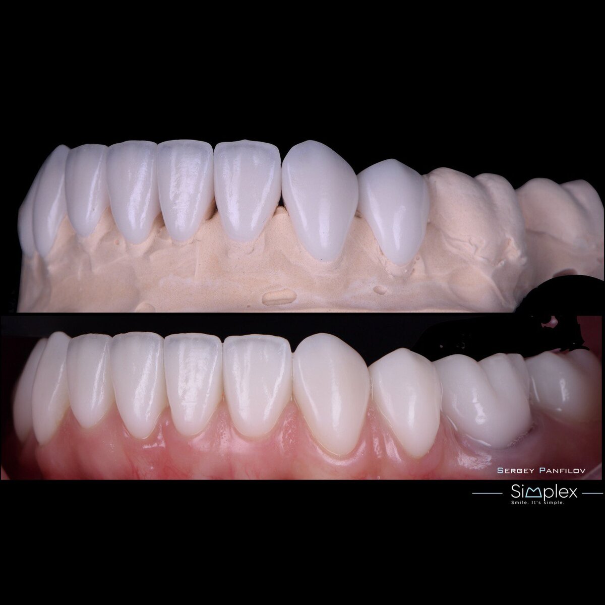 Изображение виниров на гипсовой модели и после установки 