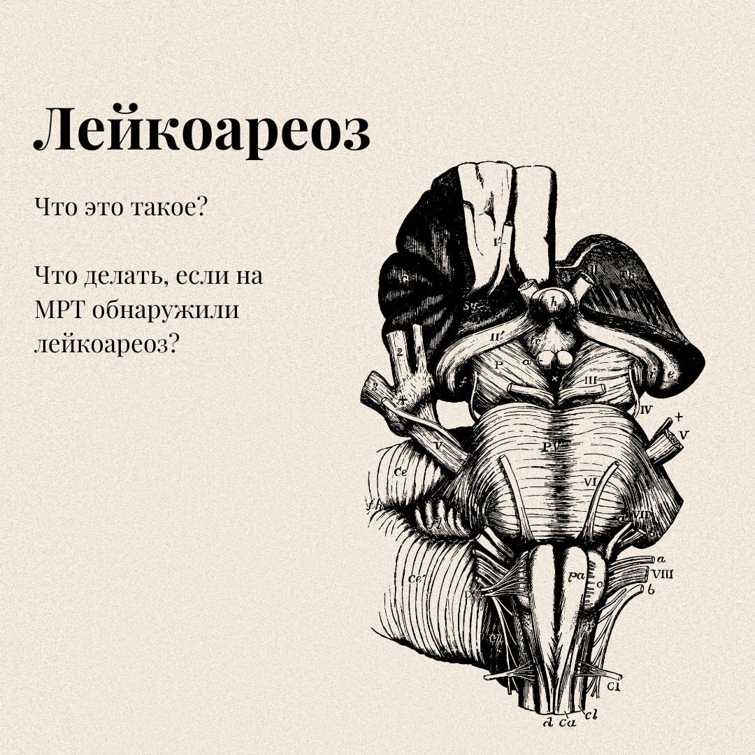 Лейкоареоз и нужно ли его опасаться? | Neurosthesia | Дзен