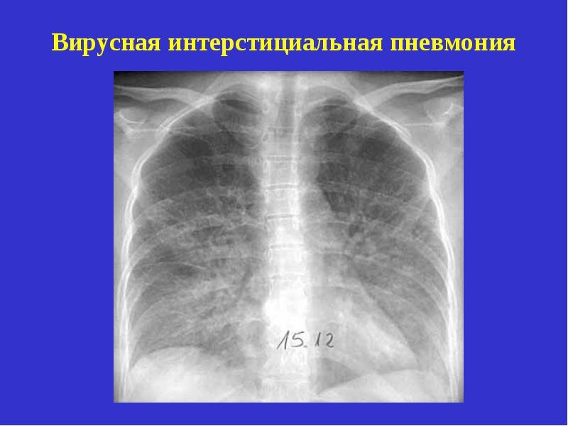 Что такое интерстициальный компонент легочного рисунка