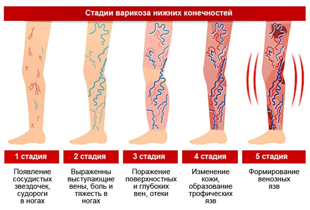 Денас при варикозе схема