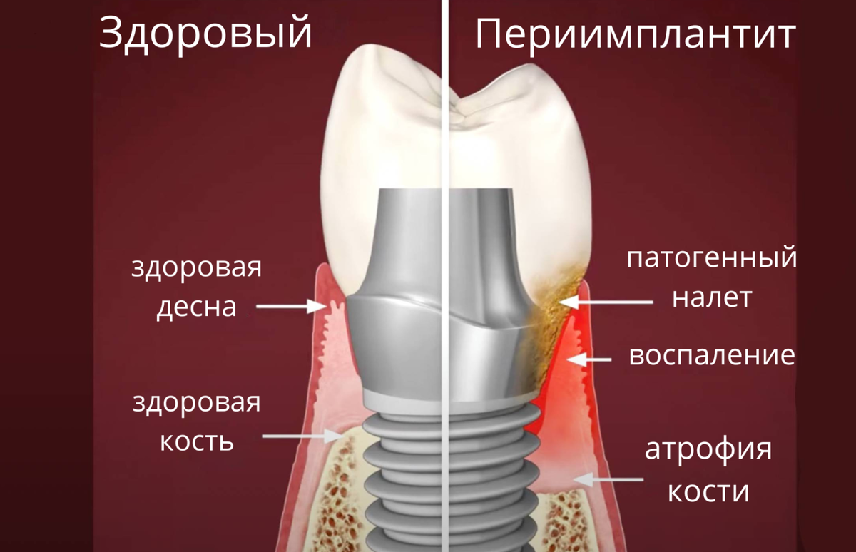 Биологическая ширина имплантат